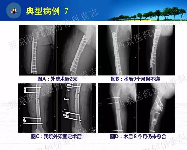 【推荐】股骨干骨不连怎么办？