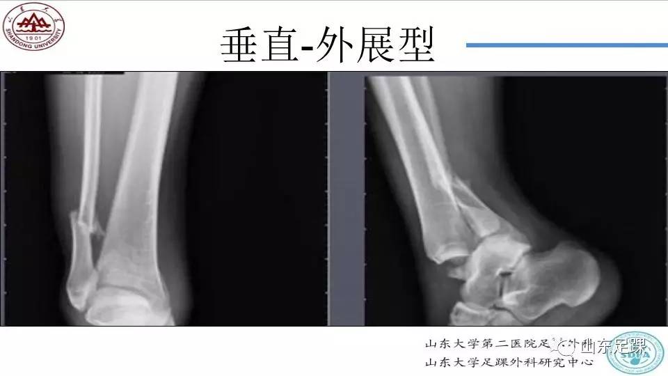 踝关节骨折的Lauge-Hansen分型