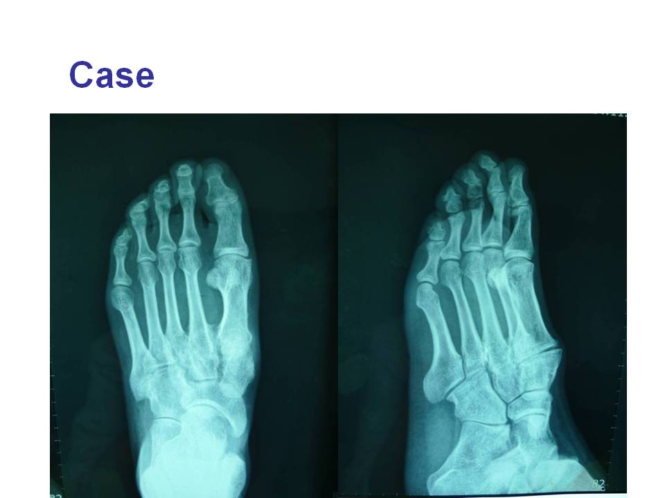 跖跗关节（Lisfranc）损伤的治疗技巧