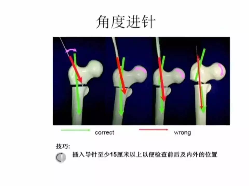 PFN内固定治疗股骨粗隆间骨折技巧