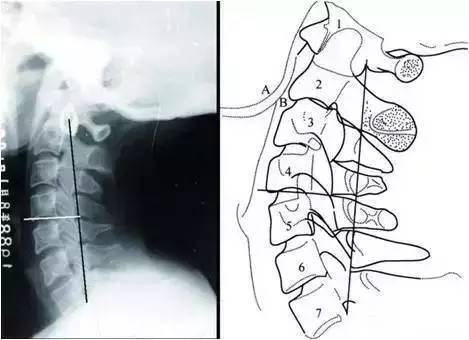  颈椎X线平片读片诊断口诀