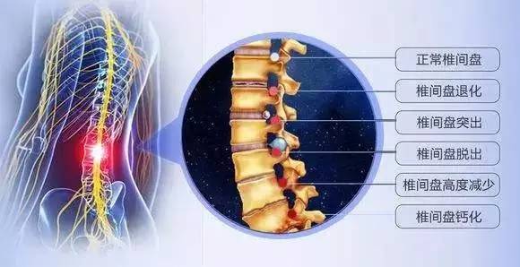腰椎间盘突出可以保守治疗吗？