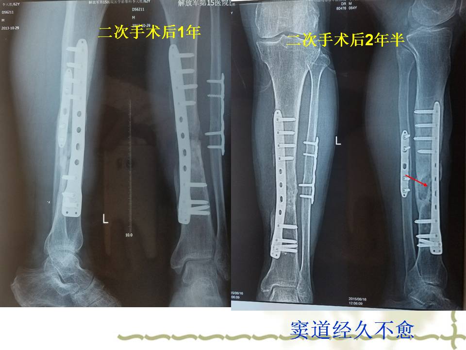 难治性骨髓炎的综合治疗策略