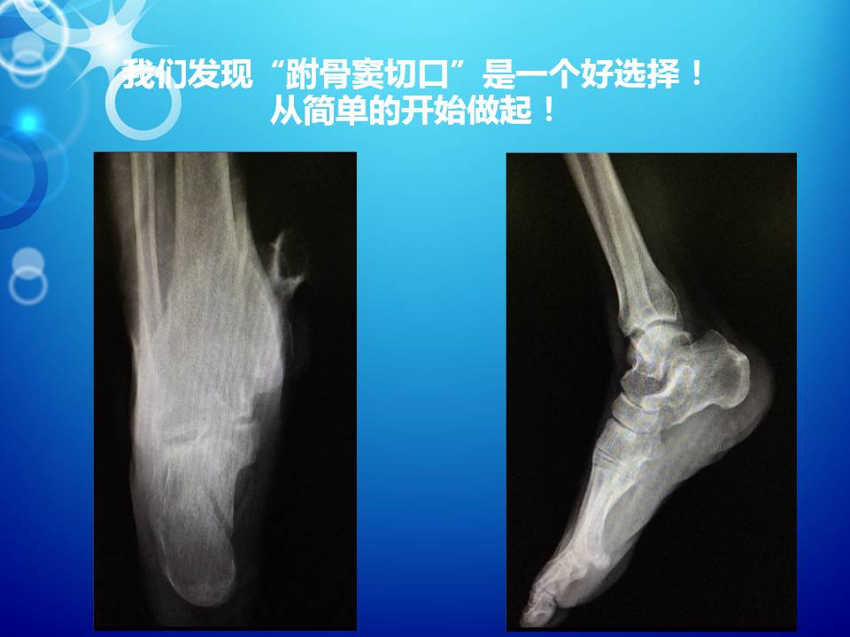 跗骨窦切口治疗跟骨骨折