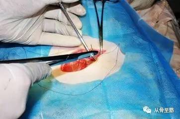 外科手术后，伤口为什么会脂肪液化？