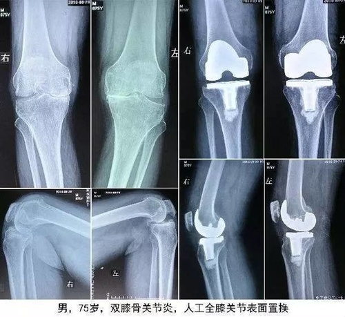人工全膝关节置换手术技术汇总
