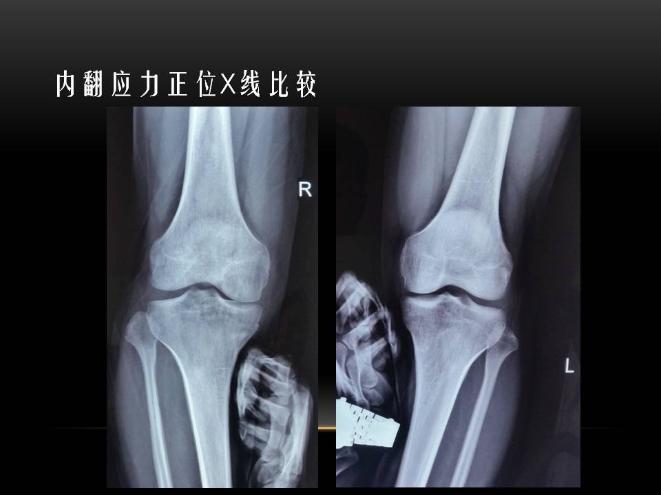 膝关节骨挫伤的分类及特点