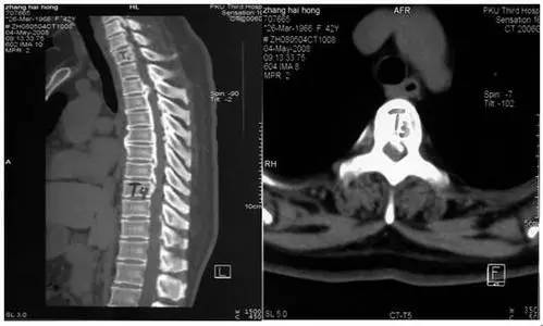 诊断胸椎管狭窄症时拍哪种片子更好？CT还是MRI还是其它