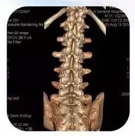 脊柱内镜治疗青少年型腰椎间盘突出症
