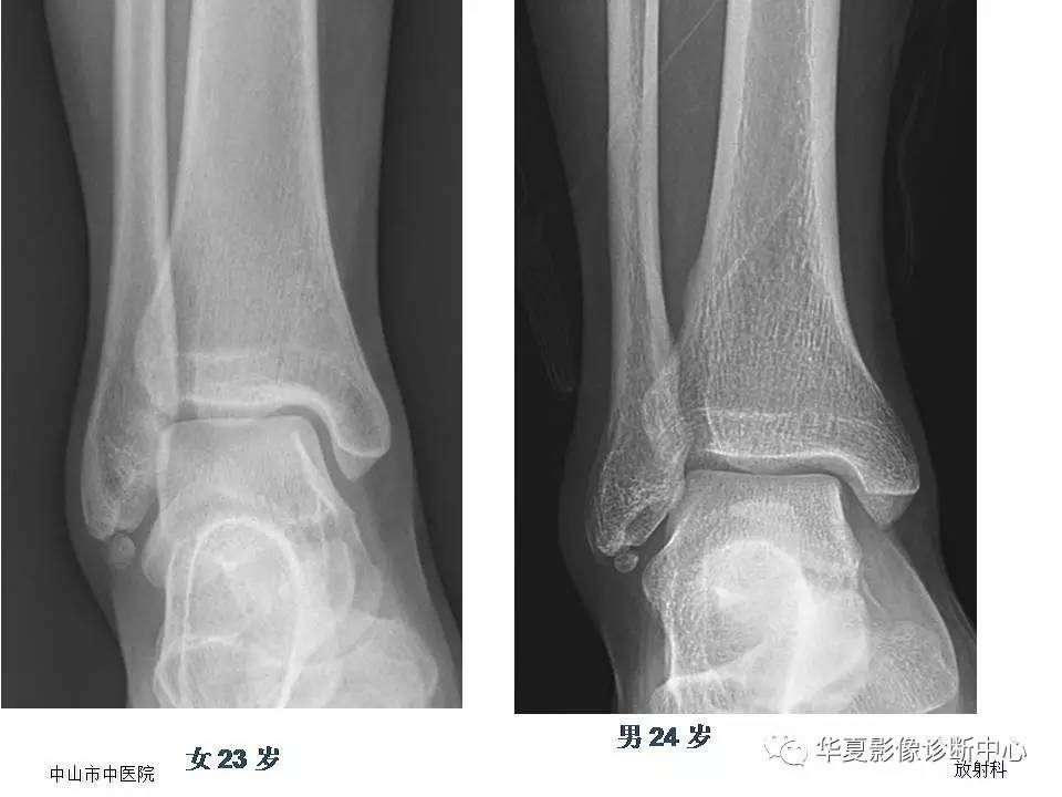 籽骨、副骨及永存骨骺，请别再误诊！