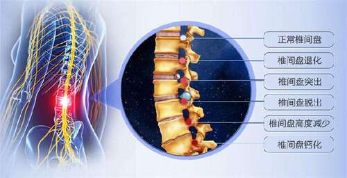 腰椎间盘突出症的诊治方法和预防