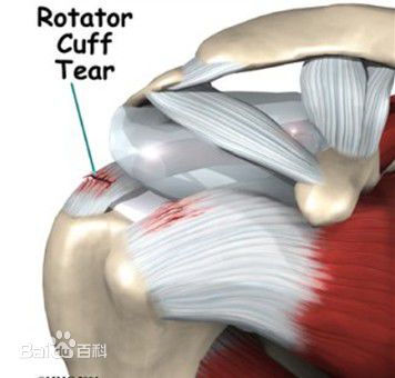 收藏 | 肩袖损伤的诊断和治疗技巧
