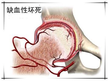 这个课件我想你需要！股骨头缺血性坏死的诊断