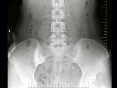 如何在CT上区分骶髂关节退变、强直、致密性髂骨炎？