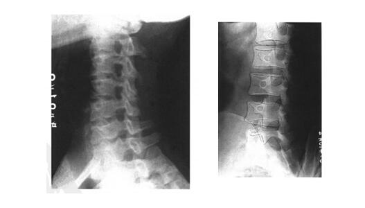 推荐 | 脊柱X片的诊断技巧