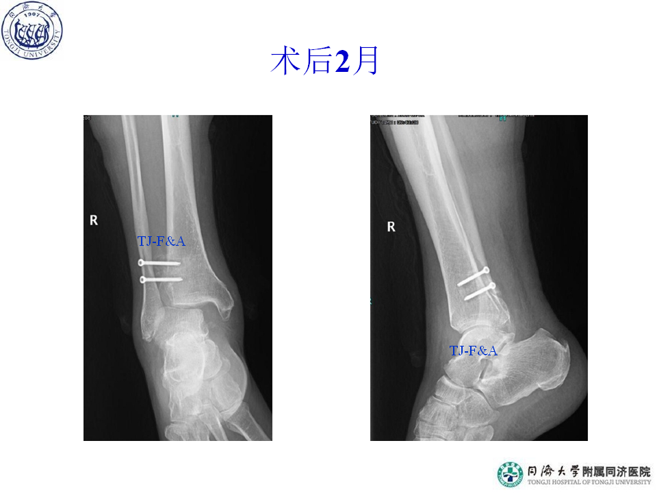 俞光荣-踝骨折的治疗策略