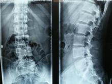 腰椎结核的分型和MRI表现是什么？