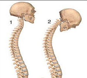 常见脊柱疾病，X线片轻松搞定！