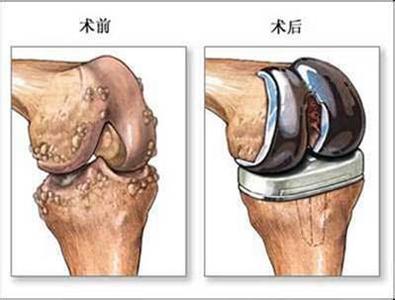 翁习生教授：人工全膝关节表面置换术—软组织处理篇