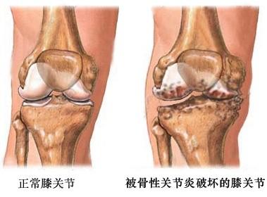 膝关节骨性关节炎患者诱发膝关节疼痛的可能病因—骨质改变