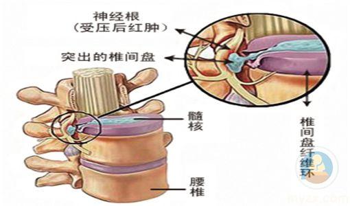 腰椎间盘突出诱发严重疼痛的治疗