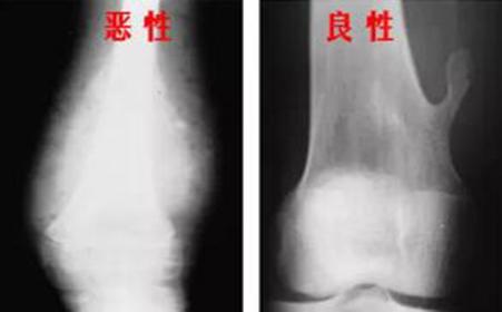 骨科医生应该确诊的良性骨肿瘤