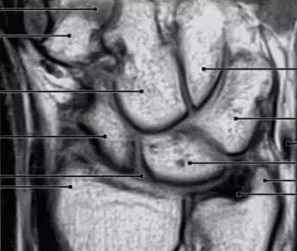 腕关节MRI检查、解剖与常见病变