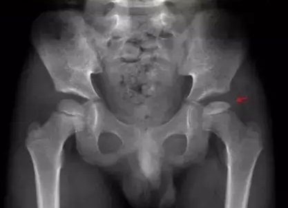 骨软骨炎的影像诊断 