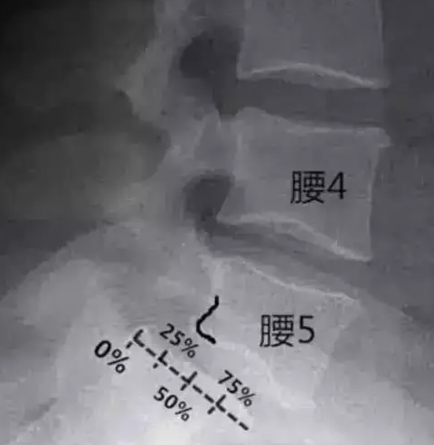腰椎滑脱分度，且看高清图解