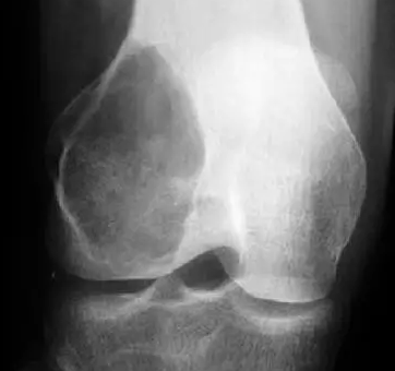 10种发生在长骨的偏心性膨胀性病变 