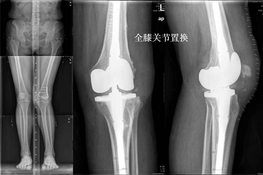 全膝关节置换的截骨要点与技巧