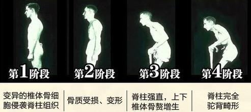强直性脊柱炎Andersson Lesion的诊断和治疗策略