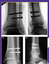 【2】国际上踝关节骨折治疗的案例分析