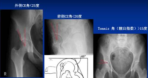 Crowe 3型及4型髋关节发育不良的手术入路及治疗