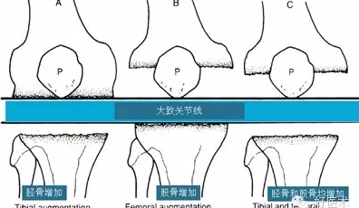 TKA翻修术中严重骨缺损和软组织失衡的处理