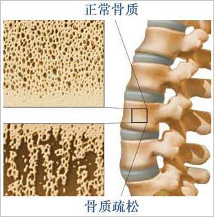 诊断骨质疏松症的6项重要指标