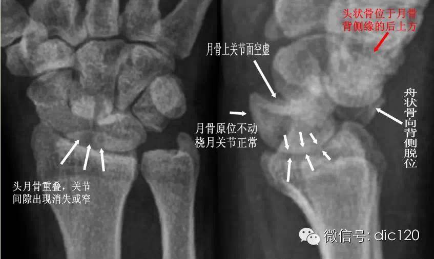 腕关节脱位的常见类型