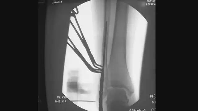 怎样微创植入腓骨髓内钉？