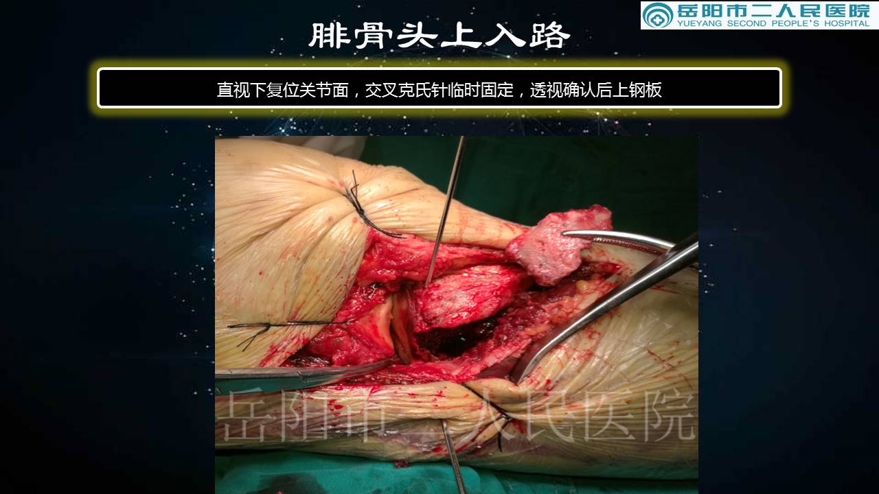 胫骨平台骨折手术入路—腓骨头上入路