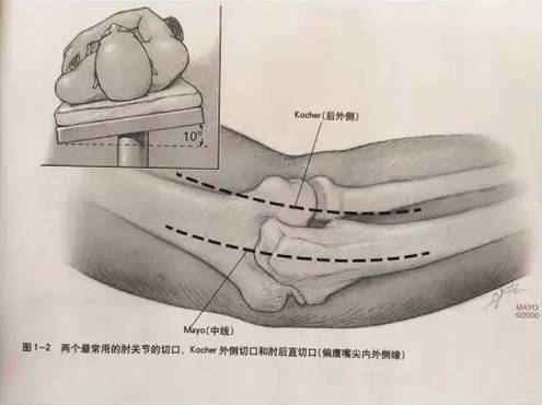 你想知道的肘关节手术入路，都在这里了
