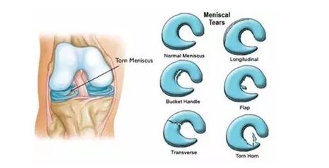 盘状半月板损伤的五大手术方法