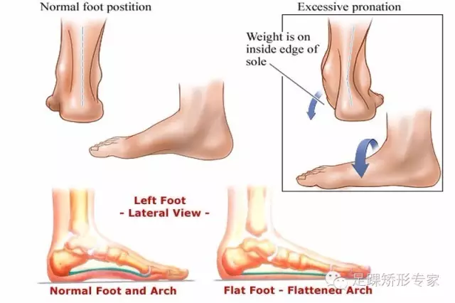 扁平足的临床诊治技巧