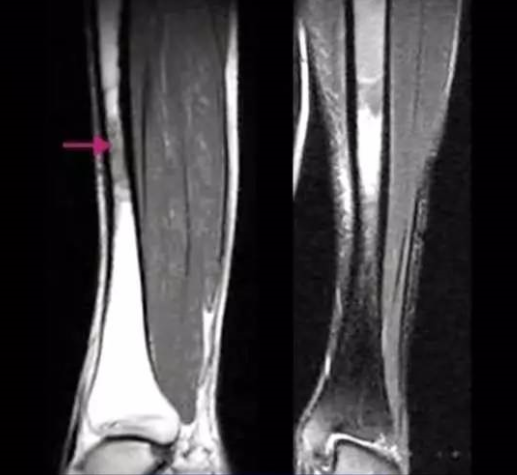 22种骨关节基本病变的MRI表现