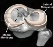 半月板损伤手术前后的MRI诊断