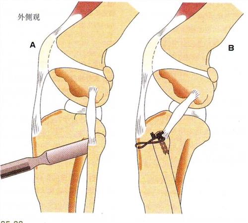 前交叉韧带断裂后应该什么时候做手术？