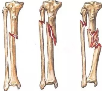 胫骨干骨折的诊断及治疗要点