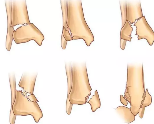Pilon 骨折的3 种手术入路及技巧