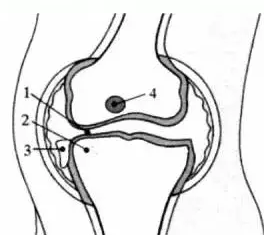 常见膝关节炎有五类，你能分清吗？