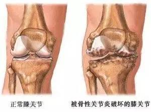 膝关节常见疾病，你知道几个？