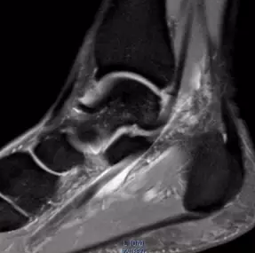 踝关节损伤的影像学诊断